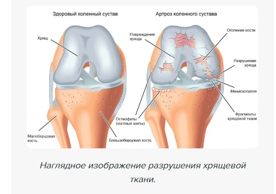 Артроскопическая коабляция коленного сустава что это такое. Artroz shema. Артроскопическая коабляция коленного сустава что это такое фото. Артроскопическая коабляция коленного сустава что это такое-Artroz shema. картинка Артроскопическая коабляция коленного сустава что это такое. картинка Artroz shema.