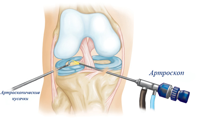 лечение колена методом артроскопии