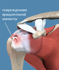 артроскопия плеча