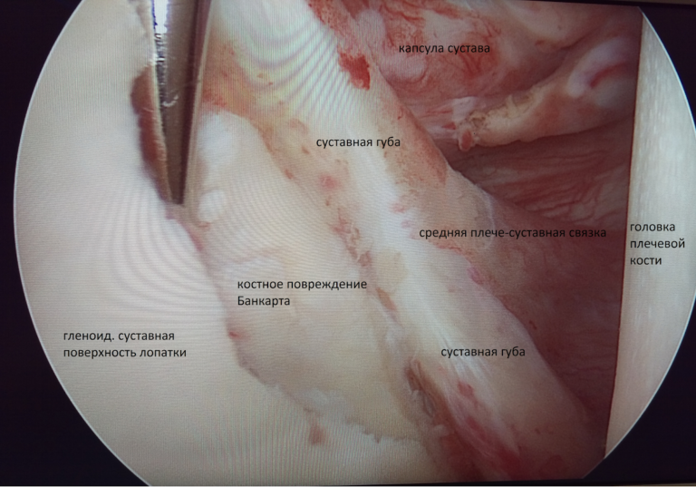 Артроскопическая операция на плечевом суставе что это. kostnyj Bankart. Артроскопическая операция на плечевом суставе что это фото. Артроскопическая операция на плечевом суставе что это-kostnyj Bankart. картинка Артроскопическая операция на плечевом суставе что это. картинка kostnyj Bankart.