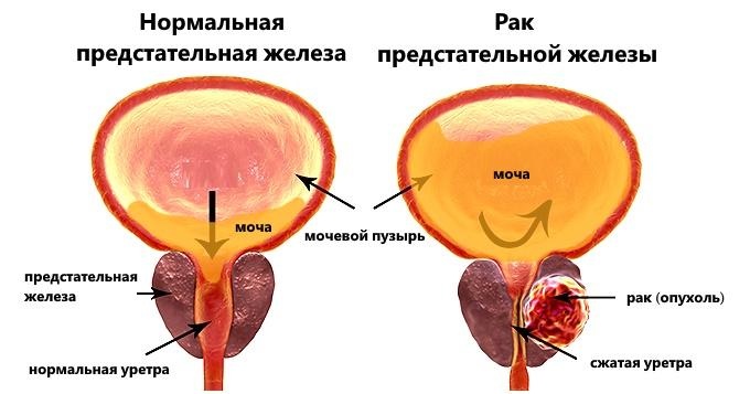 Рак предстательной железы симптомы прогноз для жизни